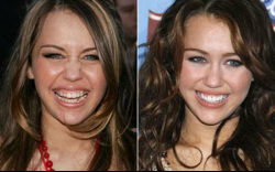 Héjkerámia technikával javított mosolyán Miley Cyrus