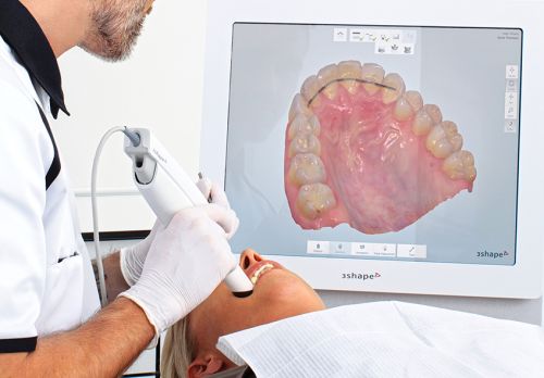 Digitális lenyomatvétel egy páciens fogsoráról a 3D oral szkenner segítségével