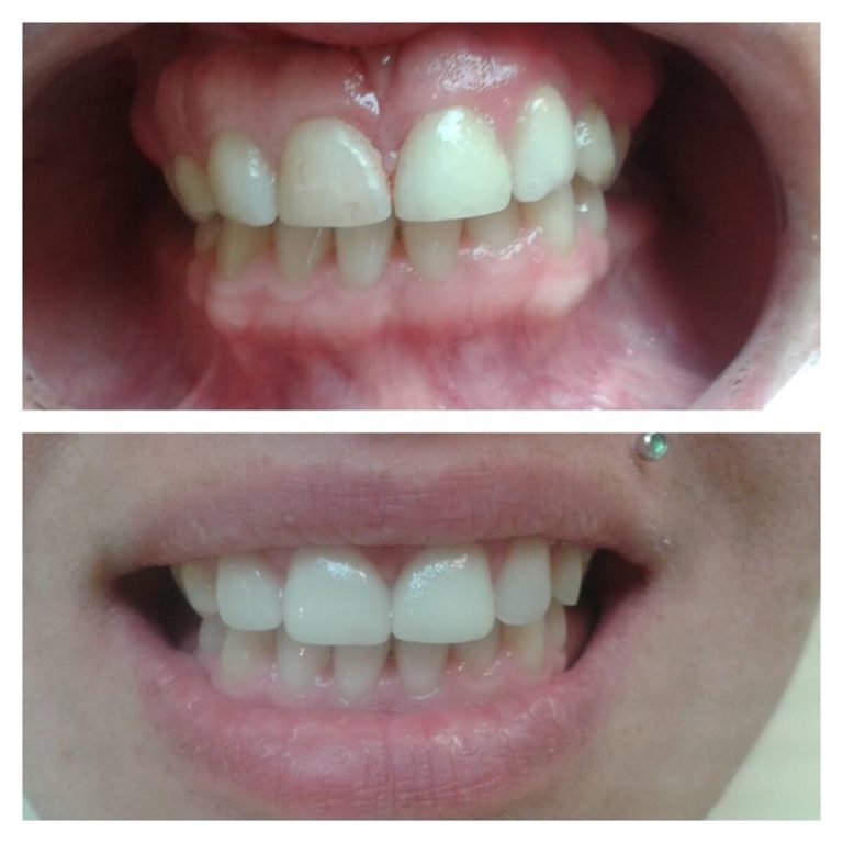 Porcelán héj felhelyezése előtt és után az Egressy Dentalnál