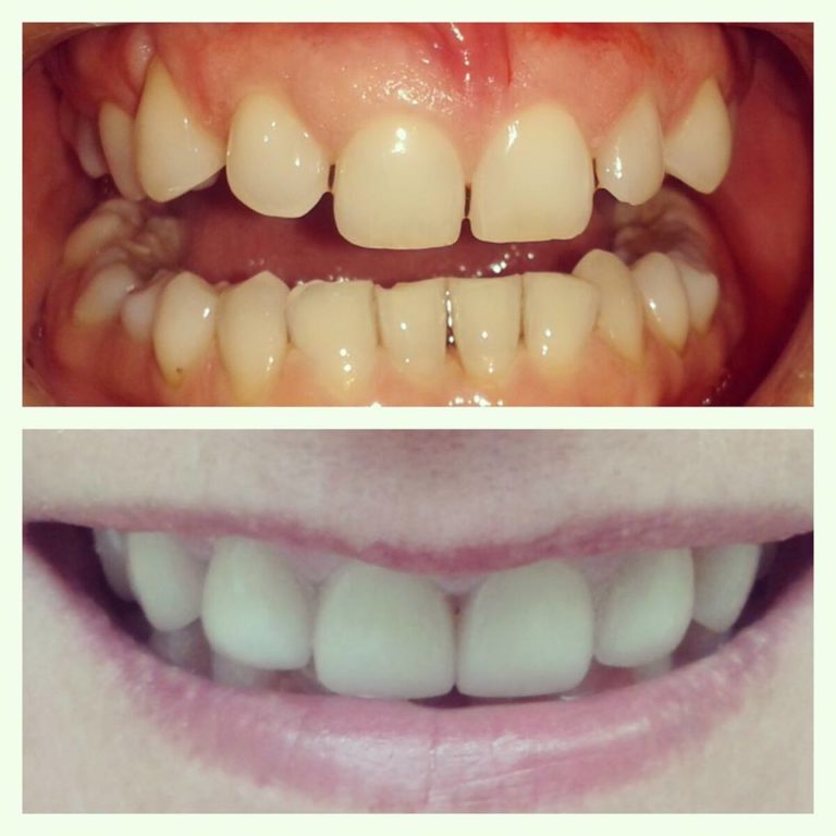 E.max porcelánhéj előtt és után az Egressy Dentalnál