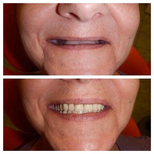 Esztétikus kivehető fogsor előtte és utána kép az Egressy Dentalnál