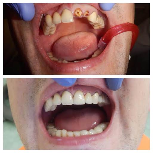 Előtte-utána képek Dr. Varga Péter fogorvos letört fogászati koronák kezeléséből