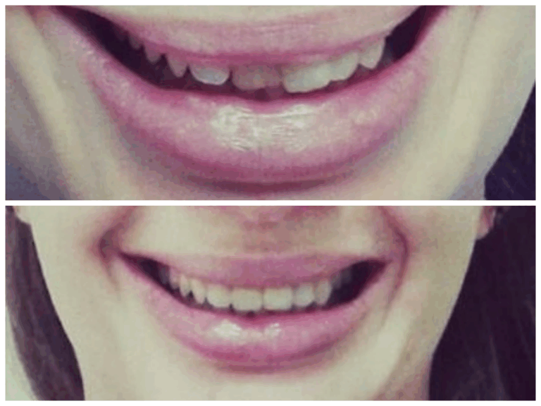 E.max préskerámia technika előtt és után az Egressy Dentalnál