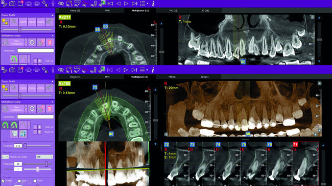 Röntgen kép a MyRay Hyperion X5 3D ceph készülékkel