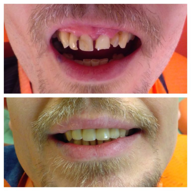 Cirkon hidas fogpótlás előtt és után az Egressy Dentalnál