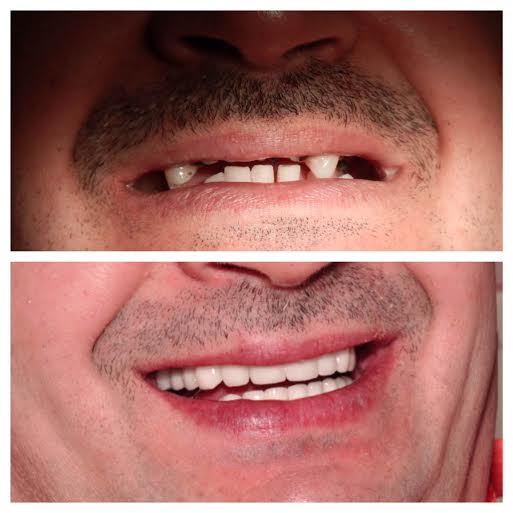 Implantátum beültetés előtt és után az Egressy Dentalnál