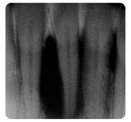 Front fogak állapota a parodontális kezelés kezdetekor