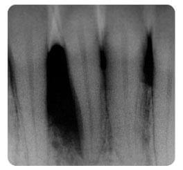Front fogak állapota 3 hónap elteltével a parodontális kezelés után