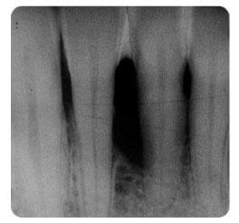 Front fogak állapota 1 év elteltével a parodontális kezelés után