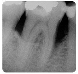 Molárisok állapota 3 év elteltével a parodontális kezelés után